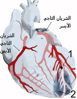 الشريانان التاجيان الأيمن والأيسر يغذيان عضلة القلب نفسها كي يعمل القلب. رسم يبيّن إحتشاء عضلة القلب، وعدم وصول الدم لجزء من عضلة القلب خلال الشريان التاجي الأيسر، بينما الشريان التاجي الأيمن مبين بصورة سليمة في الرسم أعلاه: المنطقة (1) فيها انسداد موضّح باللون الأسود داخل فرع من الشريان التاجي الأيسر الذي يُغذي الجزء السفلي من عضلة القلب. المنطقة (2) هي الجدار الأمامي لعضلة القلب، والذي لا يصله الدم بعد الإنسداد الحاصل في المنطقة (1)، ويُمكن رؤية الشريان من بعد الإنسداد وقد تغير لونه لنقص كمية الدم المارّ به، وكذلك لون المنطقة أسفل القلب المتأثرة بانسداد الشريان متغير نتيجة نقص التروية الدموية وبالتالي نقص إمداد الأكسجين.