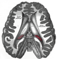 Dissection showing the ventricles of the brain.