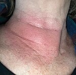 Erythema migrans ("migrating redness") on a woman's neck.[32] Rashes from non-Lyme causes may look similar.[33][34]