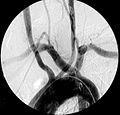 Artère sous-clavière droite aberrante à l'angiographie.