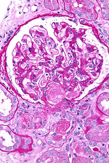 صورة مجهرية showing an acute اعتلال الأوعية الدقيقة التخثري, the علم الأنسجة correlate of DIC, in a خزعة كلوية. A خثرة is present in the نقير of the كبيبة (توضيح) (center of image). ملون حمض شيف الدوري.