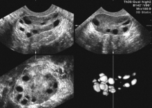 Синдром полікістозних яєчників на УЗД.png