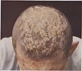 Psoriasis of the scalp