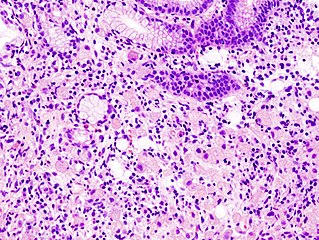 Maagzegelringcelcarcinoom. Hematoxyline-eosinekleuring.