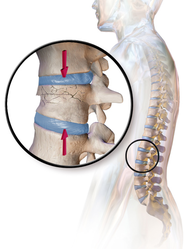 Compression fracture.