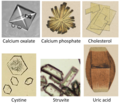 Comparison of different types of urinary crystals.