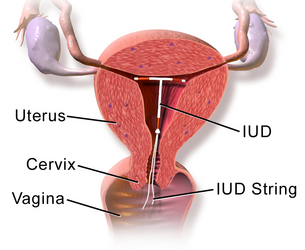 Intrauterine device.