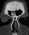 Osteoma del si frontal a la TC