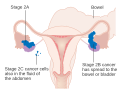 Stage 2 ovarian cancer