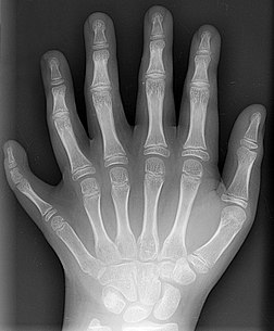 Radiographie de la main d’un patient polydactyle. (définition réelle 891 × 1 077*)