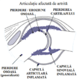 Miniatură pentru Artrită idiopatică juvenilă