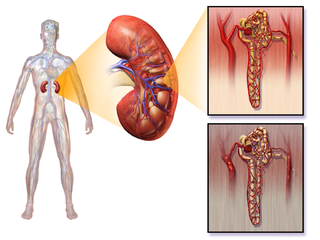 Diabetic nephropathy.