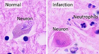 In stroke, they are beginning to infiltrate the infarcted brain after 6 to 8 hours.[65]