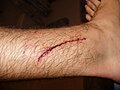 A laceration to the leg