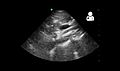 Ultrasound showing SMA syndrome[18]