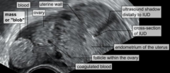 Ectopic pregnancy