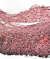 H&E stain of biopsy of normal esophagus showing the stratified squamous cell epithelium