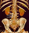 Thumbnail for Abdominal aortic aneurysm