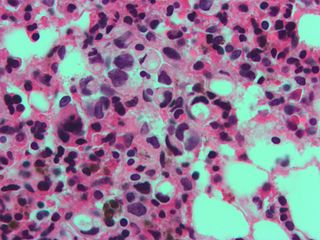 Sterke vergroting toont zegelringcellen met helder cytoplasma in een metastatisch borstcarcinoom. Hematoxyline-eosinekleuring.