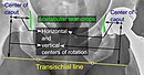 Center of rotation: The horizontal center of rotation is calculated as the distance between the acetabular teardrop and the center of the head (or caput) of the prosthesis and/or the native femoral head on the contralateral side.[88] The vertical center of rotation instead uses the transischial line for reference.[88] The parameter should be equal on both sides.[88]