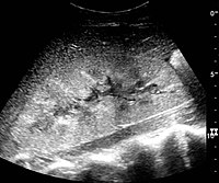 Figure 27. Postoperative renal failure with increased cortical echogenicity and kidney size. Biopsy showed acute tubular necrosis.[1]