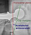 Acetabular anteversion.[91] This parameter is calculated on a lateral radiograph as the angle between the transverse plane and a line going through the (anterior and posterior) margins of the acetabular cup.[91]