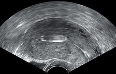 Intrauterine device