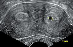 Bicornuate uterus with pregnancy