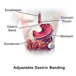 Adjustable gastric banding