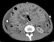 peritonitis granulomatosa.