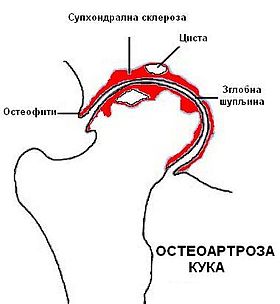 Diferencijalno dijagnostičke razlike između artroze i artritisa