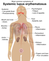 Symptoms of systemic lupus erythematosus.[14]