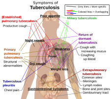 Comparison of symptoms of different variants and stages of tuberculosis