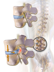 Spinal disc herniation.