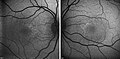 Fluorescent angiogram of a 5-year-old boy with HJMD