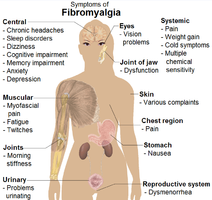 Symptoms of fibromyalgia.[13]