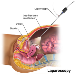 Laparoscopy.