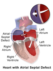 Atrial septal defect.