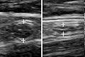 A normal appendix without and with compression. Absence of compressibility indicates appendicitis.[55]