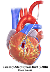 Single coronary artery bypass.