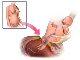 Caesarean section.