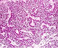 True null cell adenomas are typically composed of uniform, mildly atypical cells with chromophobic cytoplasm. This case has papillary architecture similar to gonadotroph adenomas.[55]