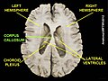 Corpus callosum