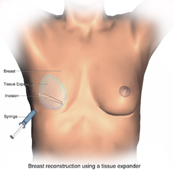 Breast reconstruction using a tissue expander.