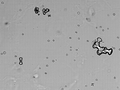 Birkaç kalsiyum oksalat monohidrat kristali (dambıl şekilli, bazıları kümelenmiş) ve bir kalsiyum oksalat dihidrat kristali (zarf şekilli) ile birkaç eritrosit gösteren idrar mikroskopisi.
