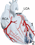 Vignette pour Infarctus du myocarde