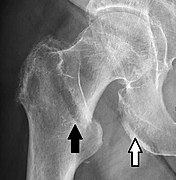 A hip fracture (black arrow) next to a skin fold (white arrow)