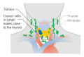 Stage N1a thyroid cancer