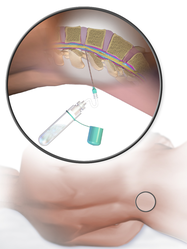 Lumbar puncture.