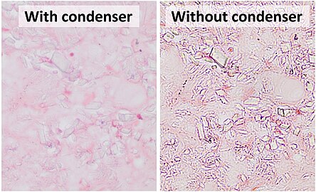 An example of a situation where microscopy without condenser is preferable at high magnification is the evaluation of crystals (calcium pyrophosphate dihydrate crystal deposition disease pictured).